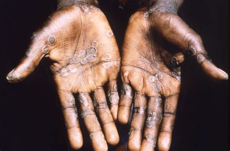 cicatrizes da varíola do macaco